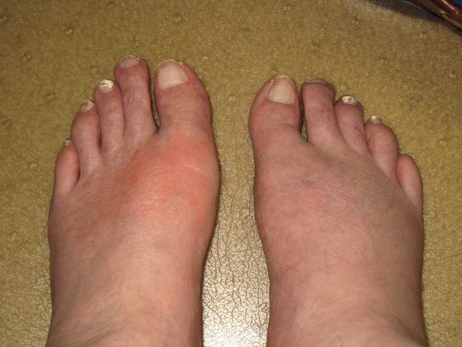 gout according to the uk gout society gout affects around one in every ...