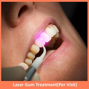 Laser Gum Treatment (per Visit)