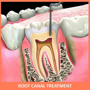 Service Provider of Root Canal Treatment with Laser New Delhi Delhi 
