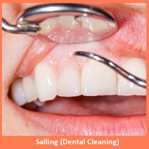 Salling (dental Cleaning)