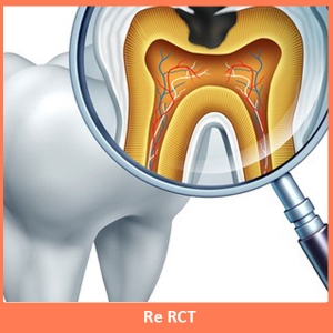 Service Provider of Root Canal Treatment New Delhi Delhi 