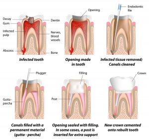 PAINLESS ROOT CANAL TREATMENT (RCT) Services in New Delhi Delhi India
