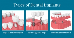Dental Implants Services in New Delhi Delhi India