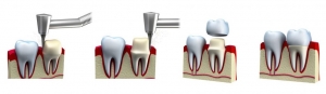 CROUNS BRIDGES AND DENTURES Services in New Delhi Delhi India