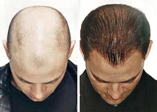 Manufacturers Exporters and Wholesale Suppliers of Baldness New Delhi Delhi