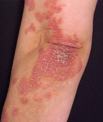Manufacturers Exporters and Wholesale Suppliers of Psoriasis New Delhi Delhi