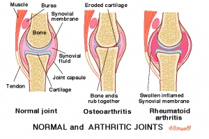 Service Provider of Arthritis Mumbai  Maharashtra 