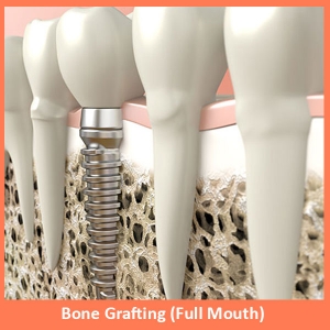 Service Provider of Bone Grafting (full Mouth) New Delhi Delhi 