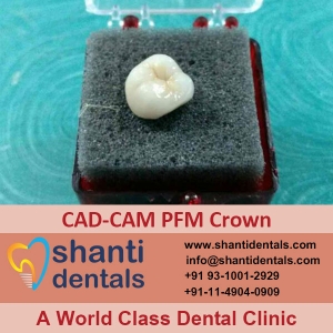 Service Provider of CAD-CAM PFM Crown New Delhi Delhi