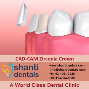 CAD-CAM Zirconia Crown Services in New Delhi Delhi India