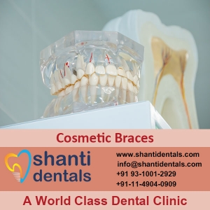 Service Provider of Cosmetic Braces New Delhi Delhi Cosmetic Braces