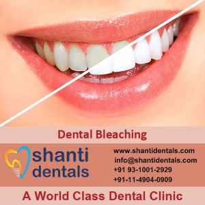 Service Provider of Dental Bleaching New Delhi Delhi