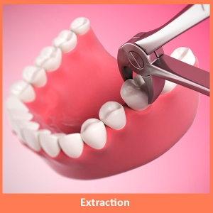 Service Provider of Dental Extraction New Delhi Delhi