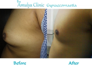 Men breast reduction surgery Services in New Delhi Delhi India