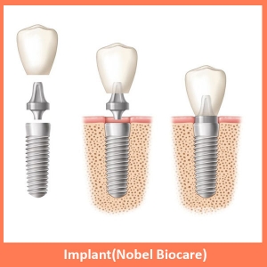 Service Provider of Implant (Nobel Biocare) New Delhi Delhi 