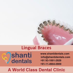 Service Provider of Lingual Braces New Delhi Delhi 