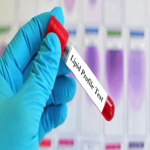 Lipid Profile Test