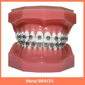 Service Provider of Dental Metal Braces New Delhi Delhi 