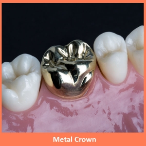 Service Provider of Dental Metal Crown New Delhi Delhi Dental Metal Crown