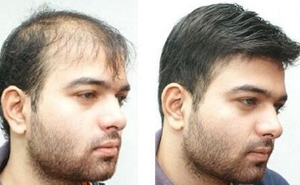 Non Surgical Hair Replacement Services Services in Mumbai Maharashtra India
