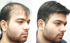 Service Provider of Non Surgical Hair Replacement Services Mumbai Maharashtra