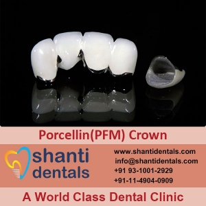 Manufacturers Exporters and Wholesale Suppliers of Porcellin (PFM) Crown New Delhi Delhi