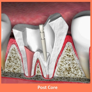 Service Provider of Dental Post Core New Delhi Delhi