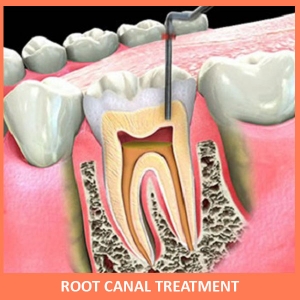 Service Provider of Root Canal Treatment (RCT) New Delhi Delhi 