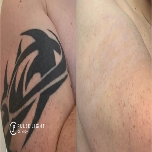 Tattoo Removal By Laser Services in Yamunanagar Haryana India