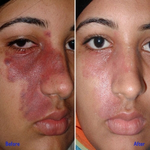 Service Provider of Birthmark Treatment Yamunanagar Haryana 