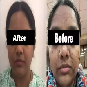 Hydra Facial Services in Yamunanagar Haryana India