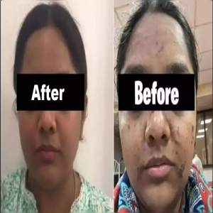 Service Provider of Hydra Facial Yamunanagar Haryana 