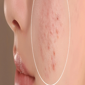 Service Provider of Acne And Acne Scar Treatment Yamunanagar Haryana 