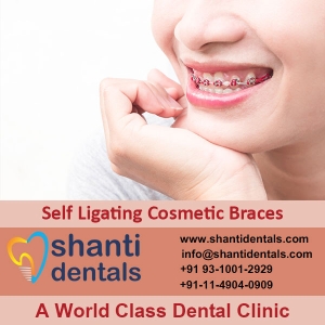 Service Provider of Self Ligating Cosmetic Braces New Delhi Delhi Self Ligating Cosmetic Braces