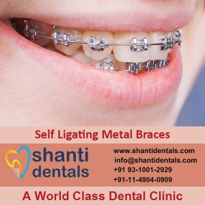 Service Provider of Self Ligating Metal Braces New Delhi Delhi 