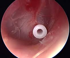 Manufacturers Exporters and Wholesale Suppliers of Ear Grommet Kolkata West Bengal