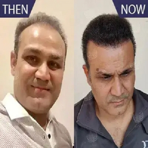 Service Provider of Hair Transplant Yamunanagar Haryana 