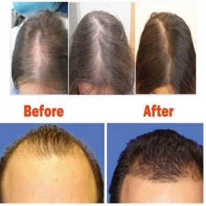 Service Provider of Hair Growth Treatment Yamunanagar Haryana