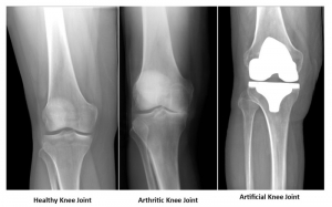 Knee Replacment Surgery