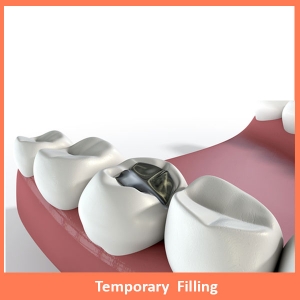 Temporary Filling