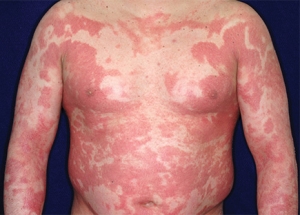 Herbal Medicine For Psoriasis Cure Manufacturer Supplier Wholesale Exporter Importer Buyer Trader Retailer in delhi Delhi India