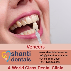 Service Provider of Veneers New Delhi Delhi Veneers