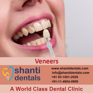 Service Provider of Veneers New Delhi Delhi